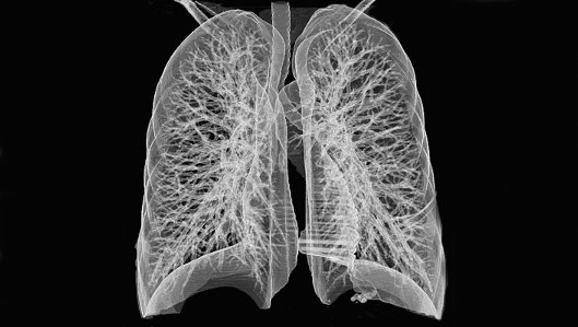 CT-Aufnahme der Lunge